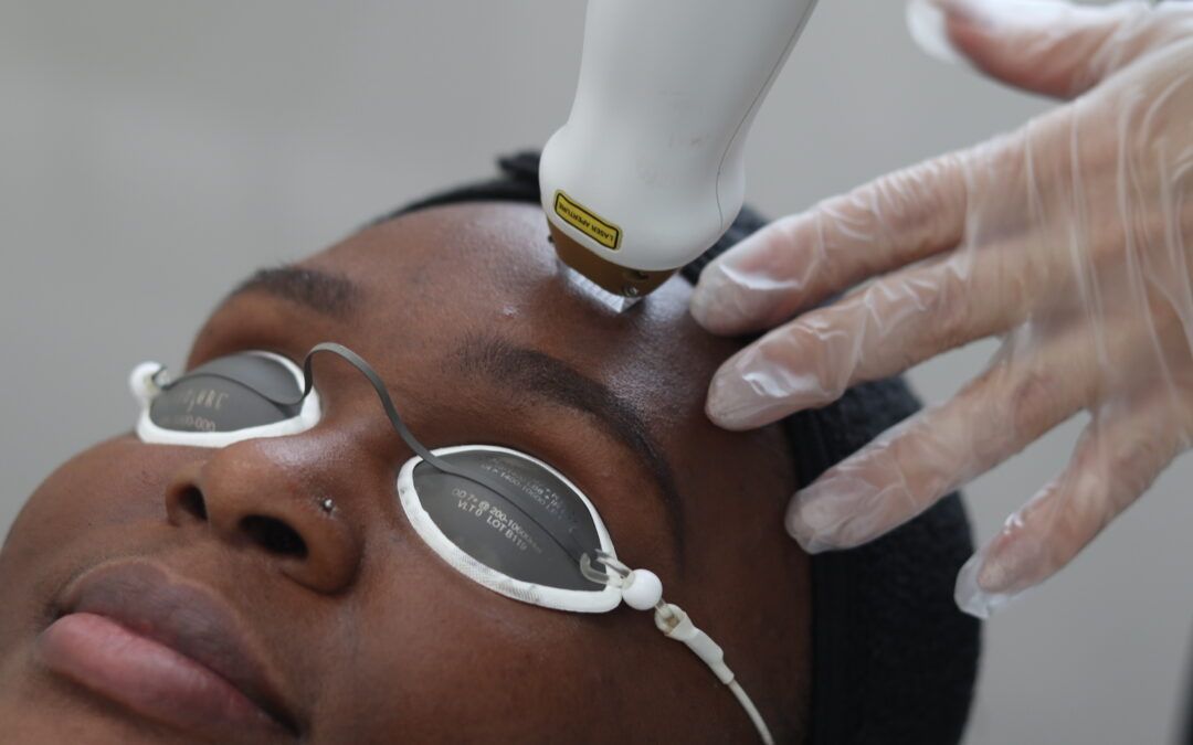 Model getting a fractional laser treatment on forehead