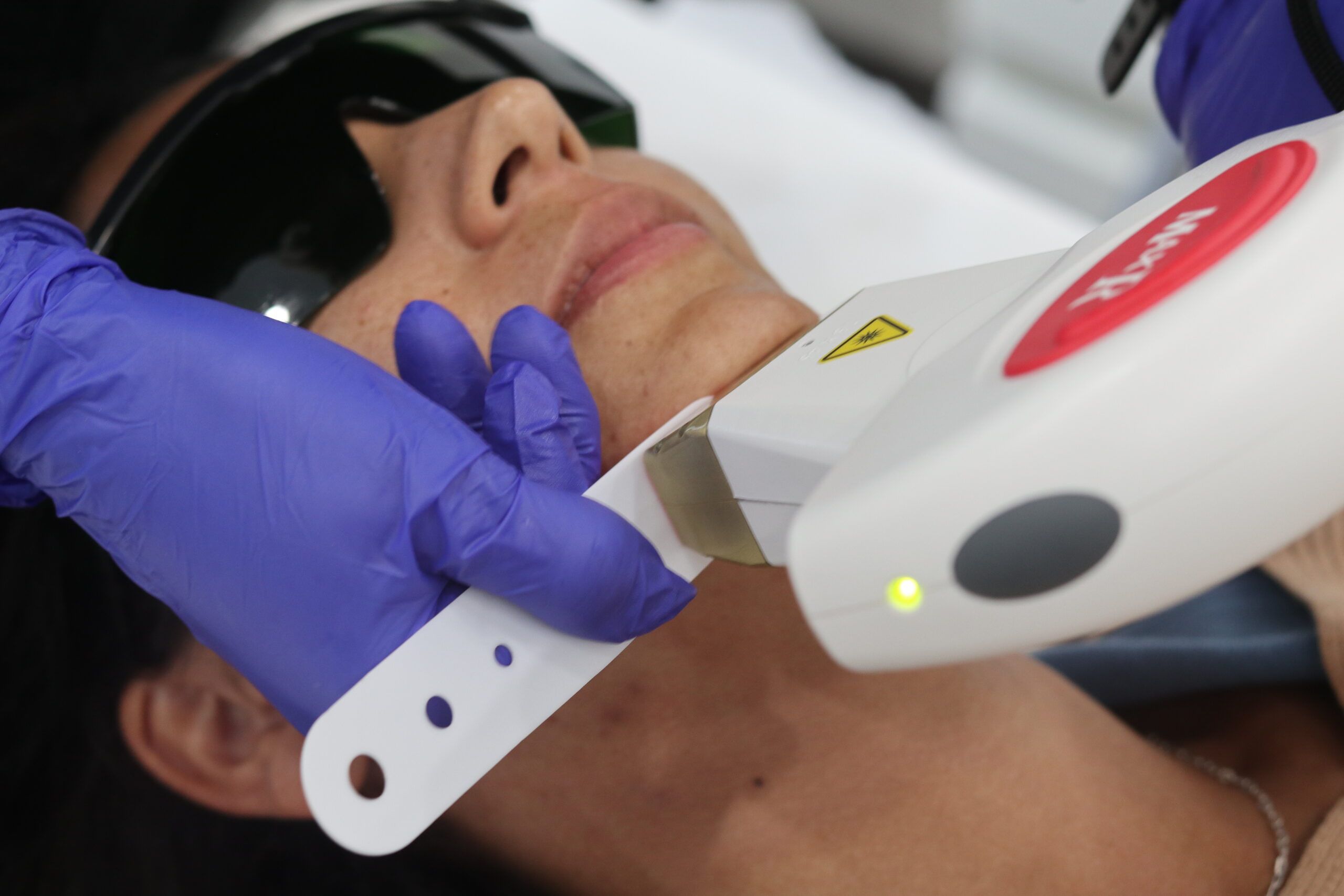 "woman getting a laser hair removal service on her chin"