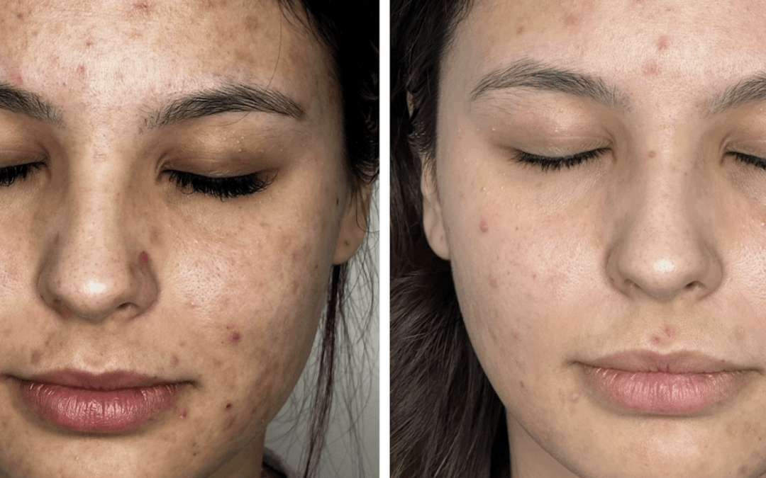 “Laser acne scar transformation”