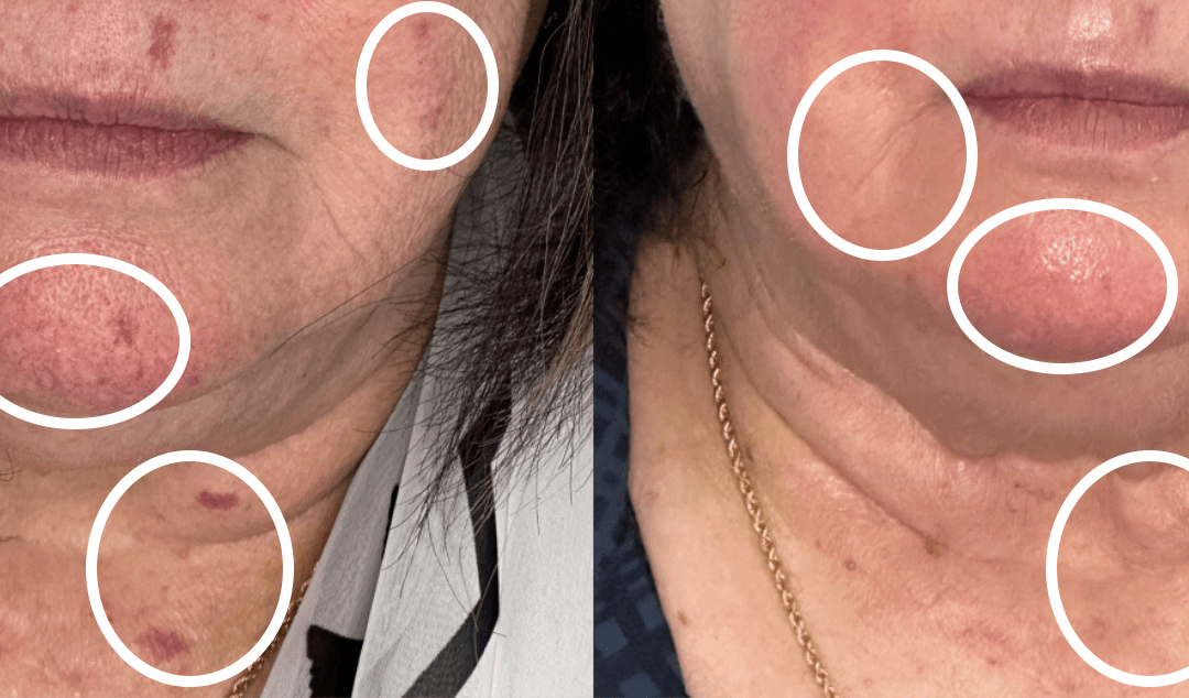 results of a laser treatment showing clearer and smoother skin