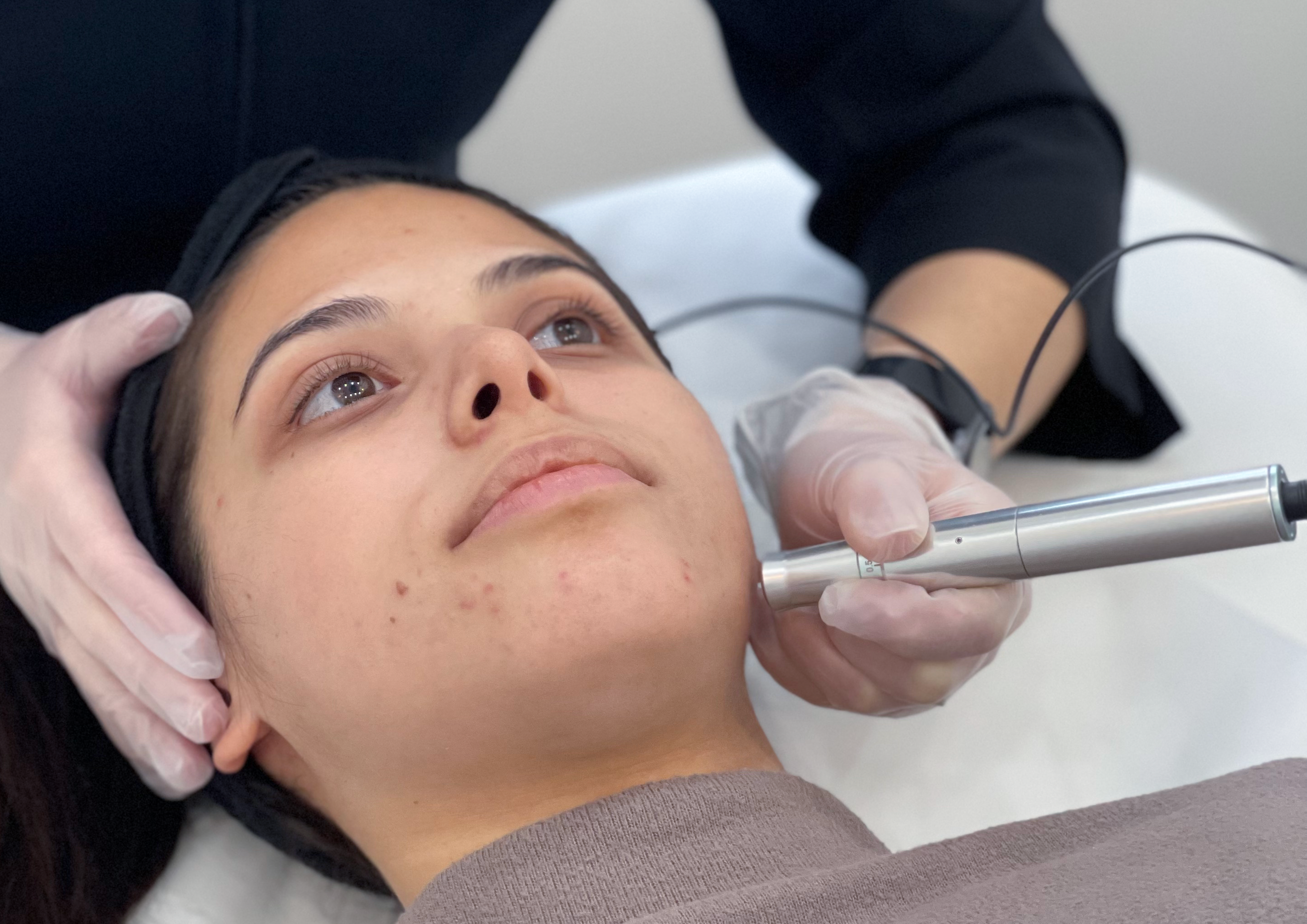 A microneedling service. Expand your career opportunities by enrolling in a comprehensive microneedling course in Winnipeg for professional training.
